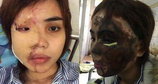 عريس يلقي مواد حارقة ويشوه وجه عروسته انتقامًا منها
