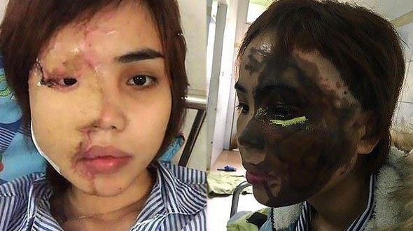 عريس يلقي مواد حارقة ويشوه وجه عروسته انتقامًا منها