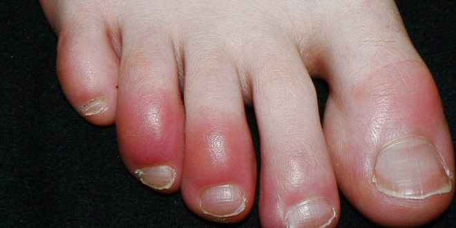 الأطباء الأسبان يحذرون قروح القدم قد تكون علامة مبكرة للإصابة بفيروس كورونا