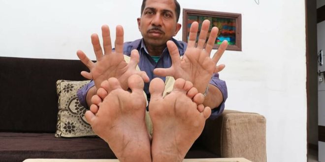 حطم الأرقام القياسية ودخل موسوعة جينيس بـ28 أصبع