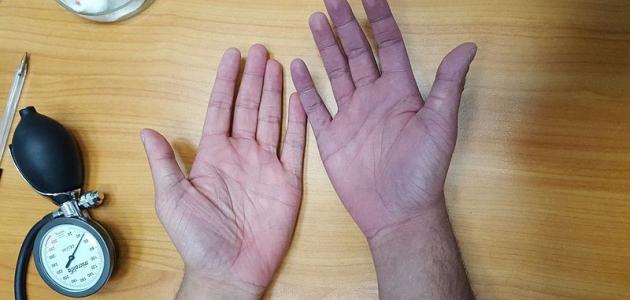 ماذا تعنى زرقة كف اليد؟ وما هى المضاعفات المترتبة عليها؟
