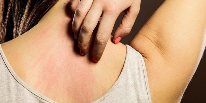 5 علامات جلدية ترتبط بفيروس كورونا
