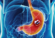 ابتعد عن تناول هذه الأطعمة على معدة فارغة أبرزها الموز والزبادى