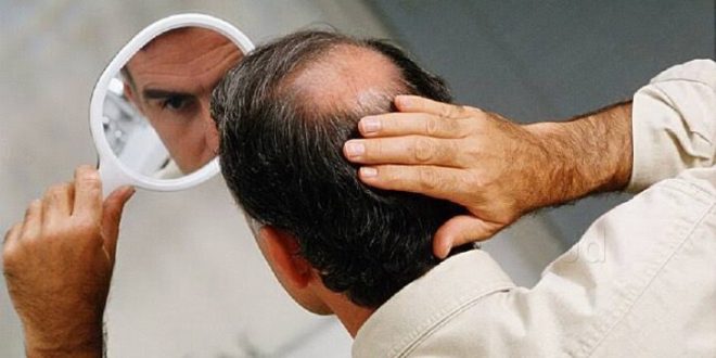 الخلايا الجذعية أمل جديد فى علاج حالات الصلع عند الرجال