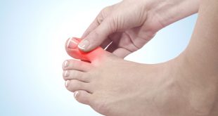 تعرف على اعراض الاصابه بالنقرس