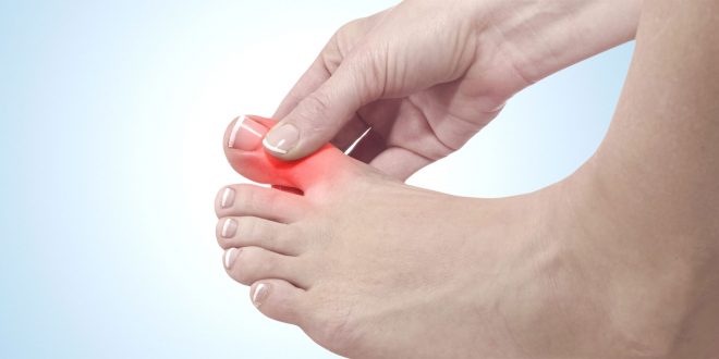 تعرف على اعراض الاصابه بالنقرس