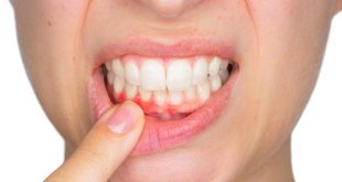 تعرف على الطرق المختلفه لعلاج ورم وتضخم اللثة