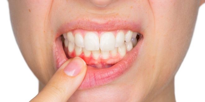 تعرف على الطرق المختلفه لعلاج ورم وتضخم اللثة