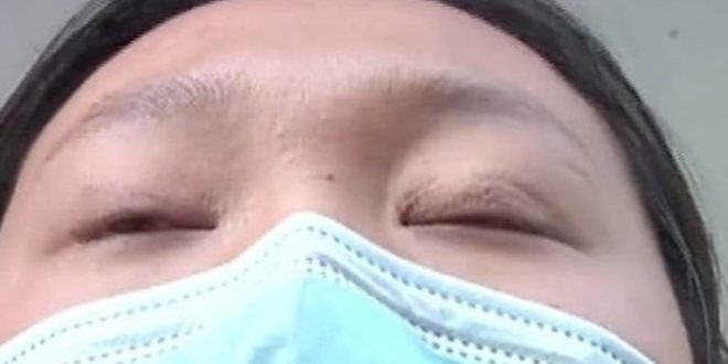 صينية لا تستطيع النوم إلا بغلق عينيها بـ"شريط لاصق" بعد جراحة تجميلية فاشلة