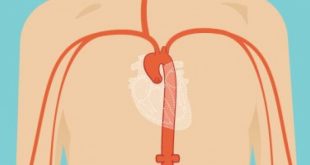 الفيروس التاجى يهاجم الأوعية الدموية ويسبب الجلطات
