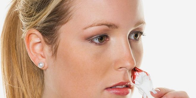 تعرف على أسباب الاصابه بنزيف الأنف