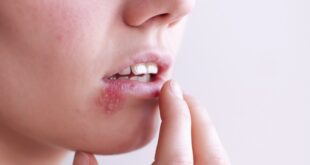 ما هو تحليل فيروس إبشتاين بار EBV؟