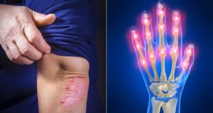 تعرف على الطرق المختلفة لعلاج التهاب المفاصل