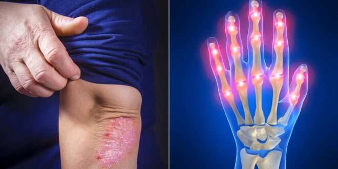 تعرف على الطرق المختلفة لعلاج التهاب المفاصل