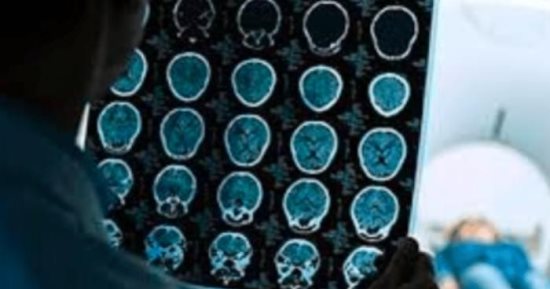 جلطة دماغية تمنح إيطاليا لكنة أجنبية جديدة فى حالة نادرة