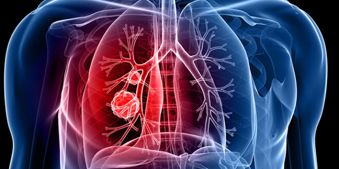 ما هو مرض سرطان الرئة وعلامات الاصابه به