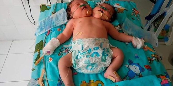 وفاة توأمين ملتصقين بفارق 3 ساعات فى أوزبكستان بعد 9 أيام من ولادتهما