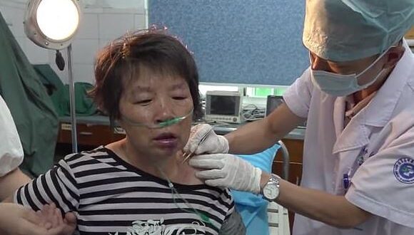 صينية تزيل آثار 400 لدغة نحلة من جسدها بعد تعرضها لهجوم