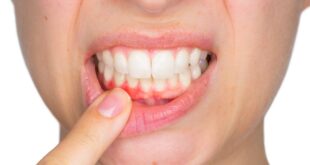 هل يمكن لأمراض اللثة أن تجعل فيروس كورونا أكثر خطرا