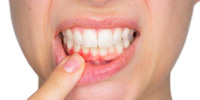 هل يمكن لأمراض اللثة أن تجعل فيروس كورونا أكثر خطرا
