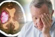 ورم الدماغ عند البالغين.. أسبابه وعوامل الخطر المرتبطة به
