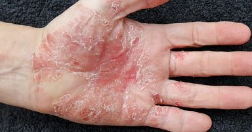 الصدفية البثرية.. أسباب الإصابة وأنواعها وطرق العلاج