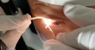 سحب 20 دودة طفيلية حية عاشت عاما كاملا في عين رجل صيني