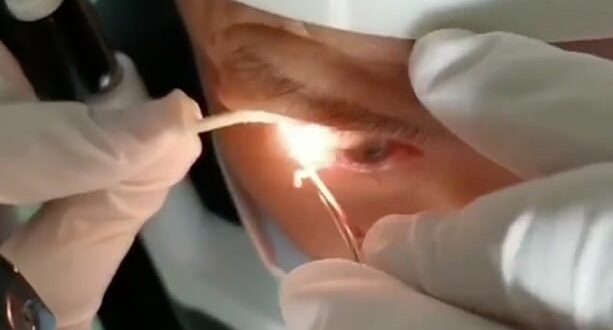 سحب 20 دودة طفيلية حية عاشت عاما كاملا في عين رجل صيني