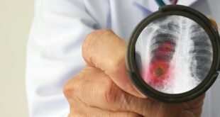 ما هى أسباب تكون جلطات الدم لدى مرضى كورونا وطرق الوقاية منها؟
