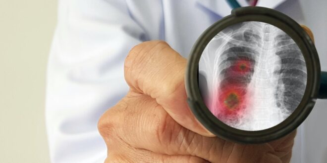 ما هى أسباب تكون جلطات الدم لدى مرضى كورونا وطرق الوقاية منها؟