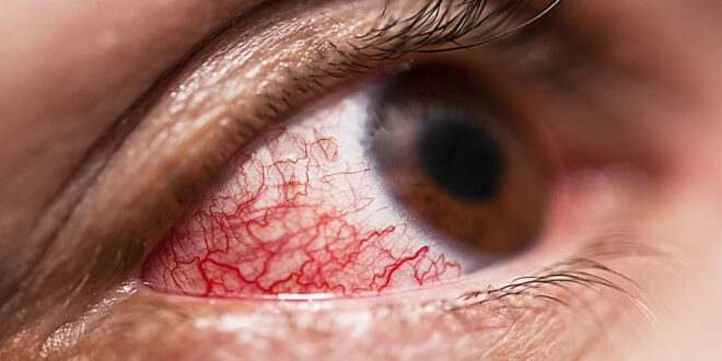 أسباب الشعور بالألم في زاوية العين.. أبرزها التهاب الجفن