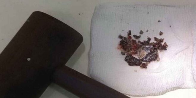 أطباء يزيلون عملة معدنية لروسى بعد 53 عاما من وضعها بأنفه