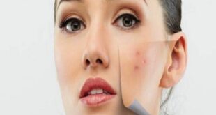 وصفات طبيعية لعلاج حب الشباب فى وقت قصير