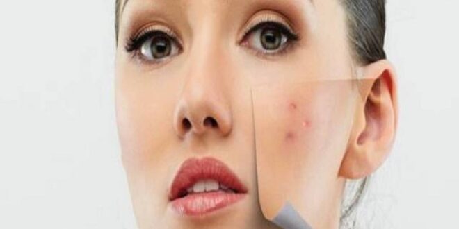 وصفات طبيعية لعلاج حب الشباب فى وقت قصير