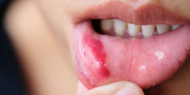 استمرار التهاب الفم أكثر من أسبوعين قد يكون علامة على الإصابة بالسرطان