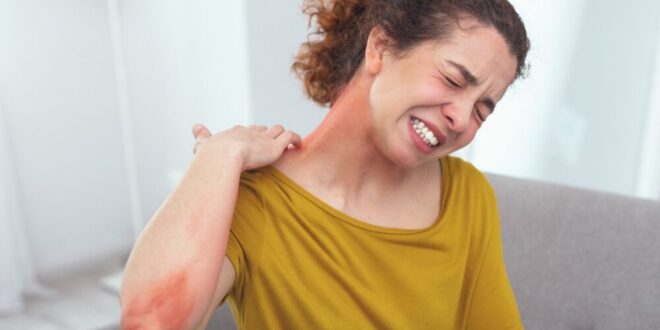 الحكة الحادة لدى مرضى الإكزيما سببها حساسية من البيئة المحيطة