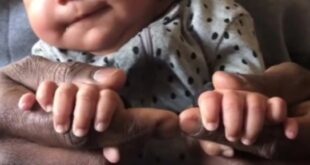 تفاعل كبير مع فيديو 'تيك توك' لطفلة بريطانية مولودة بـ12 إصبعا فى يديها