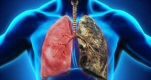 لماذا يصاب مرضى كورونا بمضاعفات تصل للإصابة بالانسداد الرئوى؟