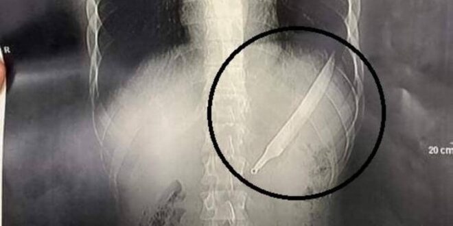مصري يبتلع سكينا طوله 27 سنتيمترا.. والأطباء يصنعون معجزة