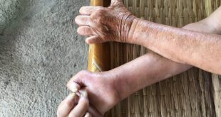 أعراض الجذام تستغرق 20 عاما لاكتشافها وعزلة المريض تسبب مرضا نفسيا