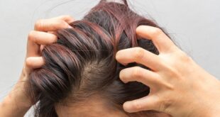 وصفات طبيعية للتخلص من حكة فروة الرأس