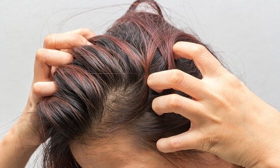 وصفات طبيعية للتخلص من حكة فروة الرأس