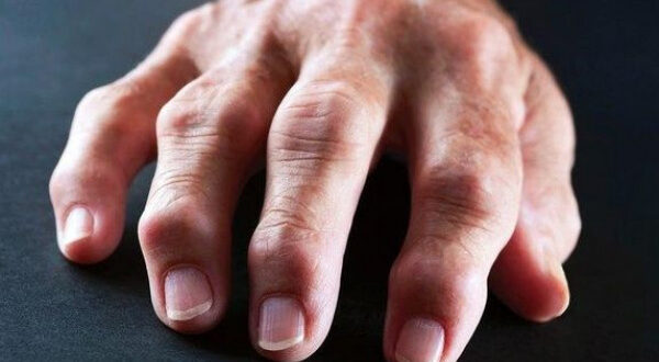 10 أسباب محتملة وراء تورم أصابع اليد