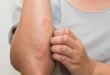 5 طرق للوقاية من أعراض الاكزيما والسيطرة عليها
