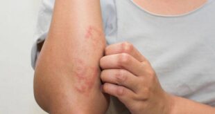 5 طرق للوقاية من أعراض الاكزيما والسيطرة عليها