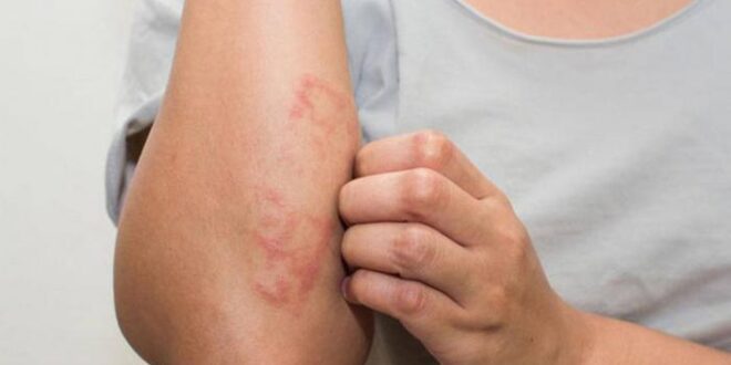 5 طرق للوقاية من أعراض الاكزيما والسيطرة عليها