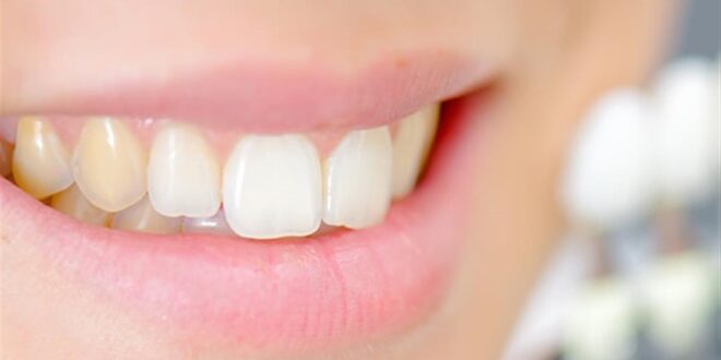 تبييض الأسنان في المنزل، 7 طرق طبيعية للتخلص من اصفرار الأسنان