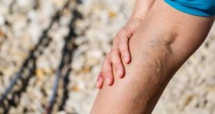 تعرف على أسباب إكزيما الدوالى بالساقين وأعراض الإصابة بها