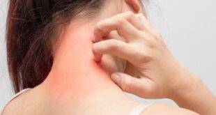 ما هى الفيتامينات التى يمكن أن تساعد فى التحكم بأعراض الصدفية؟
