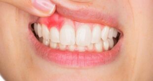 كيف يمكن أن تزيد أمراض اللثة من مخاطر الإصابة بالنوبة القلبية؟